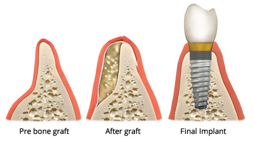 Dental Implant Bone Grafting