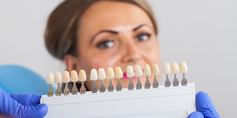 tooth shade matching for dental veneers