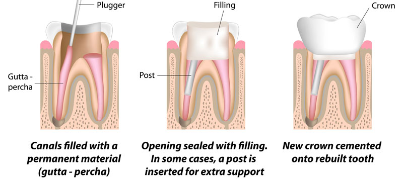 Root canal procedure after infection