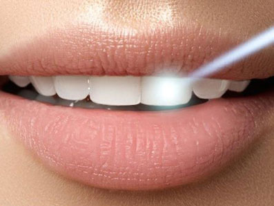 laser dentistry beam on teeth